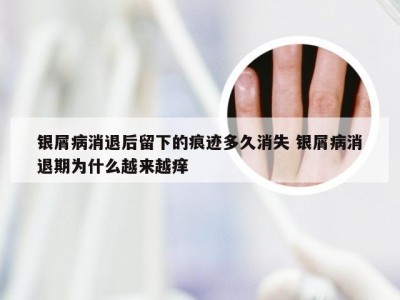 银屑病消退后留下的痕迹多久消失 银屑病消退期为什么越来越痒