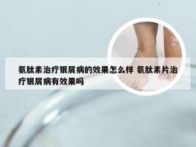 氨肽素治疗银屑病的效果怎么样 氨肽素片治疗银屑病有效果吗