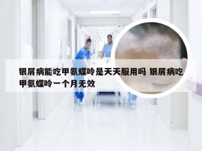 银屑病能吃甲氨蝶呤是天天服用吗 银屑病吃甲氨蝶呤一个月无效