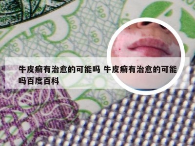 牛皮癣有治愈的可能吗 牛皮癣有治愈的可能吗百度百科