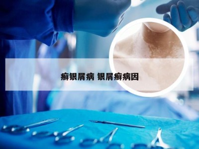 癣银屑病 银屑癣病因