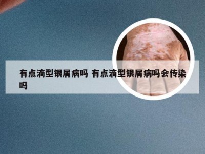 有点滴型银屑病吗 有点滴型银屑病吗会传染吗
