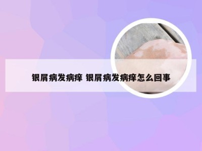 银屑病发病痒 银屑病发病痒怎么回事