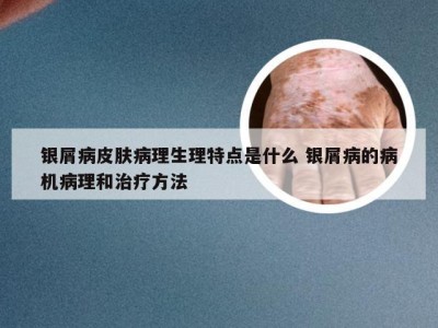 银屑病皮肤病理生理特点是什么 银屑病的病机病理和治疗方法