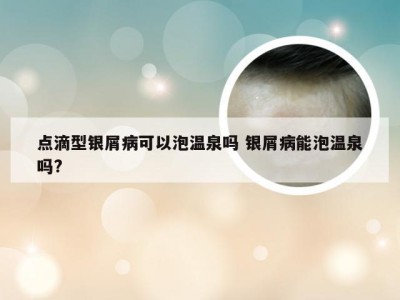 点滴型银屑病可以泡温泉吗 银屑病能泡温泉吗?