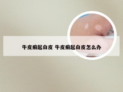 牛皮癣起白皮 牛皮癣起白皮怎么办