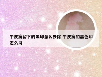 牛皮癣留下的黑印怎么去除 牛皮癣的黑色印怎么消