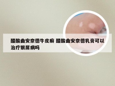 醋酸曲安奈德牛皮癣 醋酸曲安奈德乳膏可以治疗银屑病吗