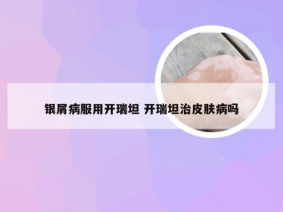 银屑病服用开瑞坦 开瑞坦治皮肤病吗