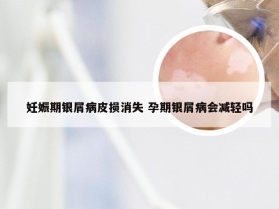 妊娠期银屑病皮损消失 孕期银屑病会减轻吗