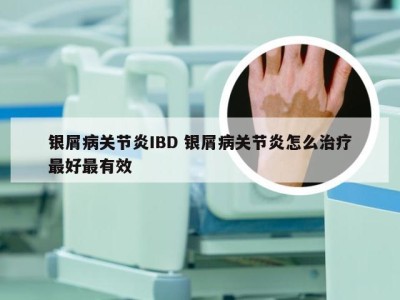 银屑病关节炎IBD 银屑病关节炎怎么治疗最好最有效