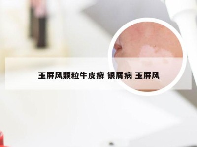 玉屏风颗粒牛皮癣 银屑病 玉屏风