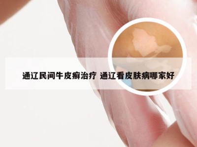 通辽民间牛皮癣治疗 通辽看皮肤病哪家好