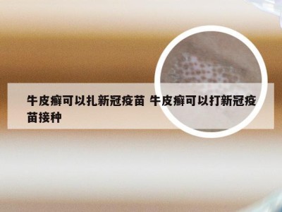 牛皮癣可以扎新冠疫苗 牛皮癣可以打新冠疫苗接种