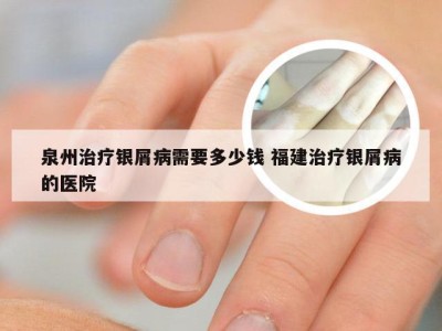 泉州治疗银屑病需要多少钱 福建治疗银屑病的医院