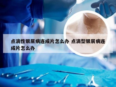 点滴性银屑病连成片怎么办 点滴型银屑病连成片怎么办