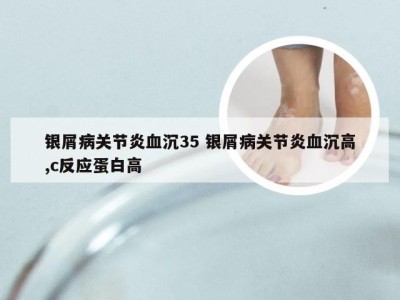 银屑病关节炎血沉35 银屑病关节炎血沉高,c反应蛋白高