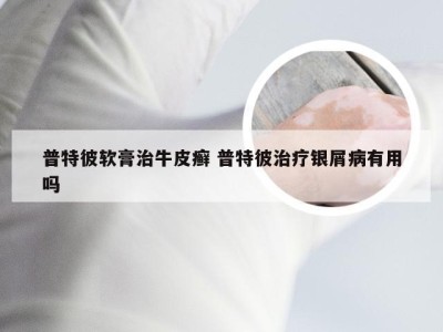 普特彼软膏治牛皮癣 普特彼治疗银屑病有用吗