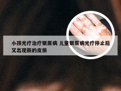 小孩光疗治疗银屑病 儿童银屑病光疗停止后又出现新的皮损