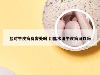 盐对牛皮癣有害处吗 用盐水洗牛皮癣可以吗