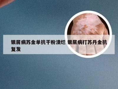 银屑病苏金单抗干粉溃烂 银屑病打苏丹金抗复发