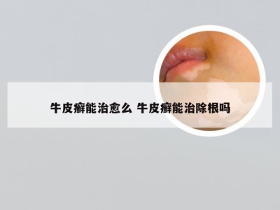 牛皮癣能治愈么 牛皮癣能治除根吗