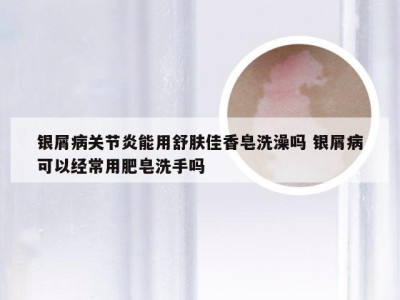 银屑病关节炎能用舒肤佳香皂洗澡吗 银屑病可以经常用肥皂洗手吗