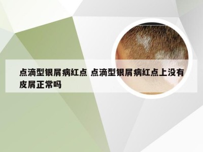 点滴型银屑病红点 点滴型银屑病红点上没有皮屑正常吗