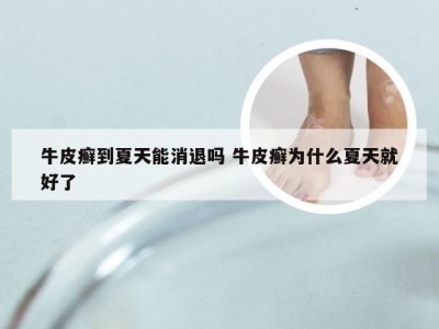 牛皮癣到夏天能消退吗 牛皮癣为什么夏天就好了