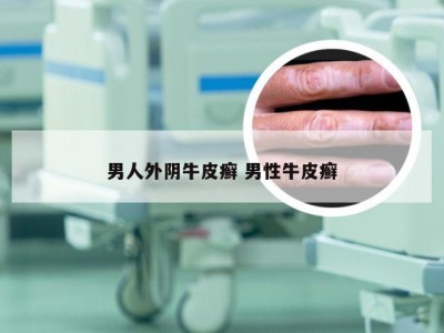 男人外阴牛皮癣 男性牛皮癣