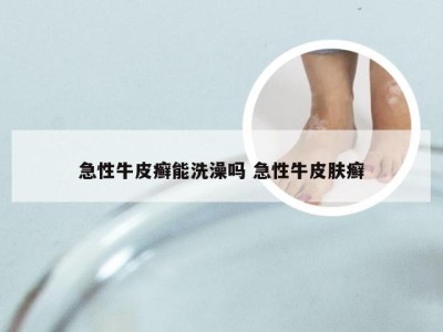 急性牛皮癣能洗澡吗 急性牛皮肤癣