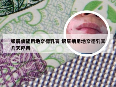 银屑病能用地奈德乳膏 银屑病用地奈德乳膏几天停用
