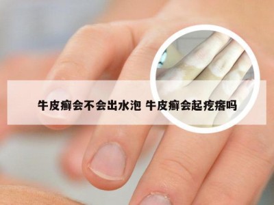 牛皮癣会不会出水泡 牛皮癣会起疙瘩吗