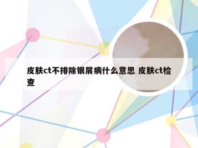 皮肤ct不排除银屑病什么意思 皮肤ct检查