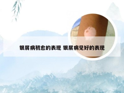 银屑病初愈的表现 银屑病见好的表现