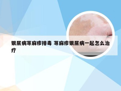 银屑病荨麻疹排毒 荨麻疹银屑病一起怎么治疗