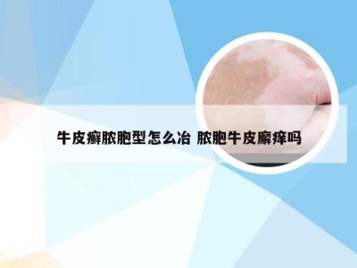 牛皮癣脓胞型怎么冶 脓胞牛皮廨痒吗