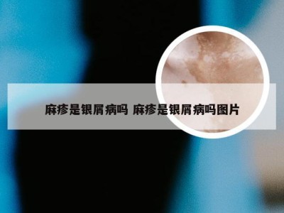 麻疹是银屑病吗 麻疹是银屑病吗图片