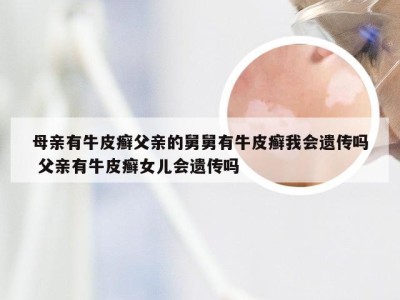 母亲有牛皮癣父亲的舅舅有牛皮癣我会遗传吗 父亲有牛皮癣女儿会遗传吗