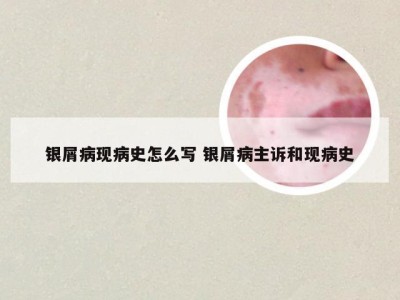 银屑病现病史怎么写 银屑病主诉和现病史