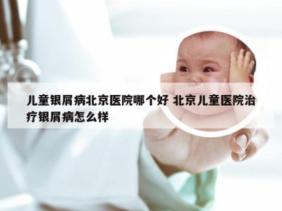 儿童银屑病北京医院哪个好 北京儿童医院治疗银屑病怎么样