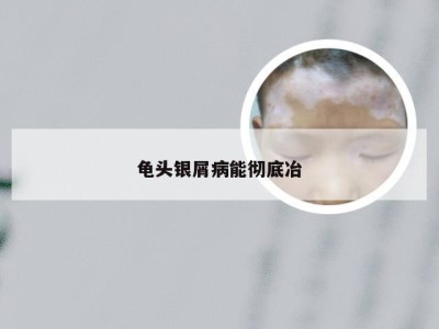 龟头银屑病能彻底冶