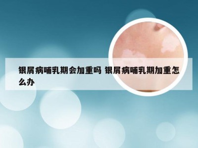 银屑病哺乳期会加重吗 银屑病哺乳期加重怎么办