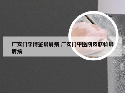 广安门李博鉴银屑病 广安门中医院皮肤科银屑病