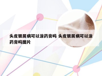 头皮银屑病可以涂药膏吗 头皮银屑病可以涂药膏吗图片
