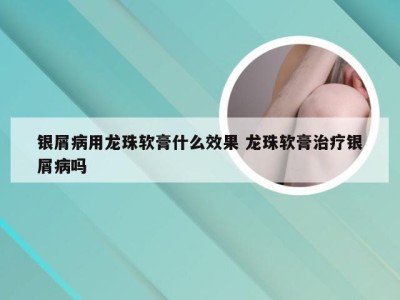 银屑病用龙珠软膏什么效果 龙珠软膏治疗银屑病吗