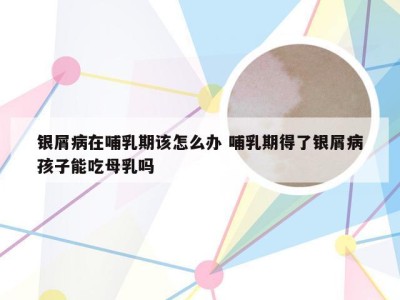银屑病在哺乳期该怎么办 哺乳期得了银屑病孩子能吃母乳吗