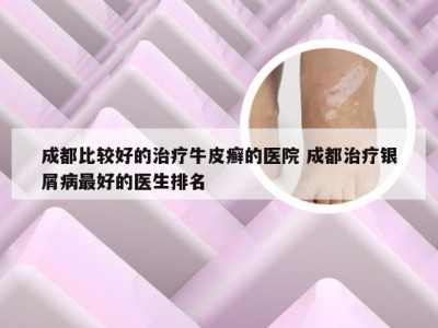 成都比较好的治疗牛皮癣的医院 成都治疗银屑病最好的医生排名