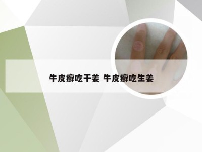 牛皮癣吃干姜 牛皮癣吃生姜