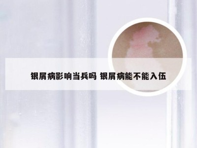 银屑病影响当兵吗 银屑病能不能入伍